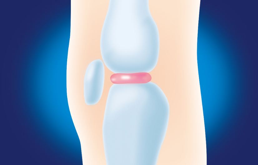軟骨がすり減る