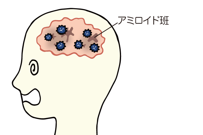 アミロイド班
